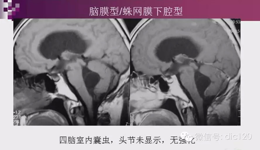 脑内环形强化病变影像诊断思路
