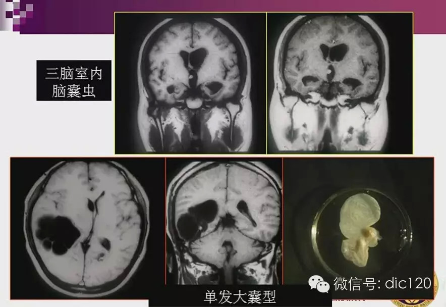 脑内环形强化病变影像诊断思路