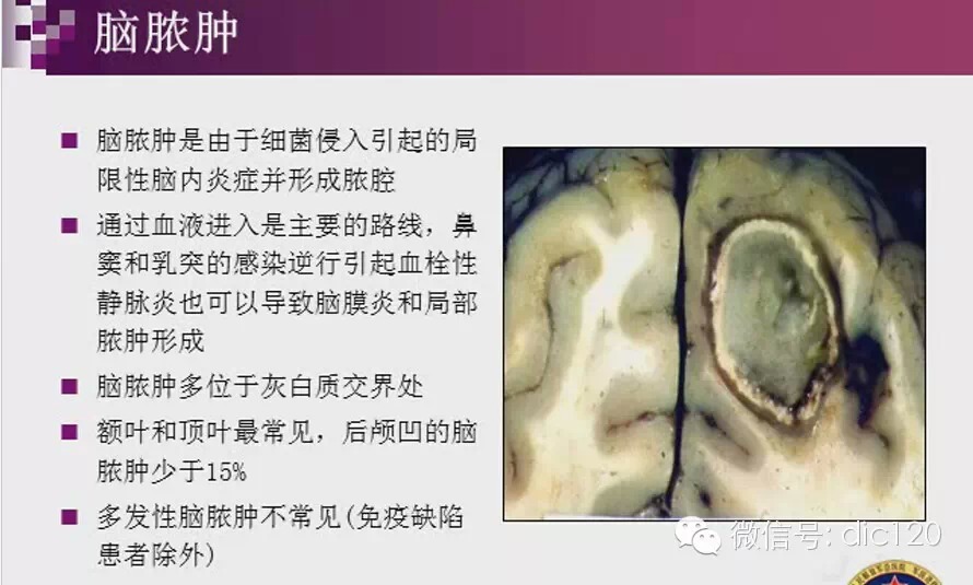 脑内环形强化病变影像诊断思路