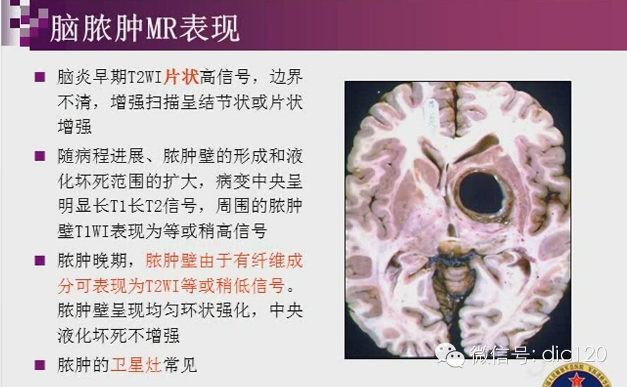 脑内环形强化病变影像诊断思路