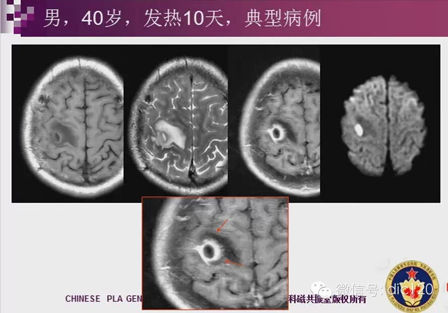 脑内环形强化病变影像诊断思路