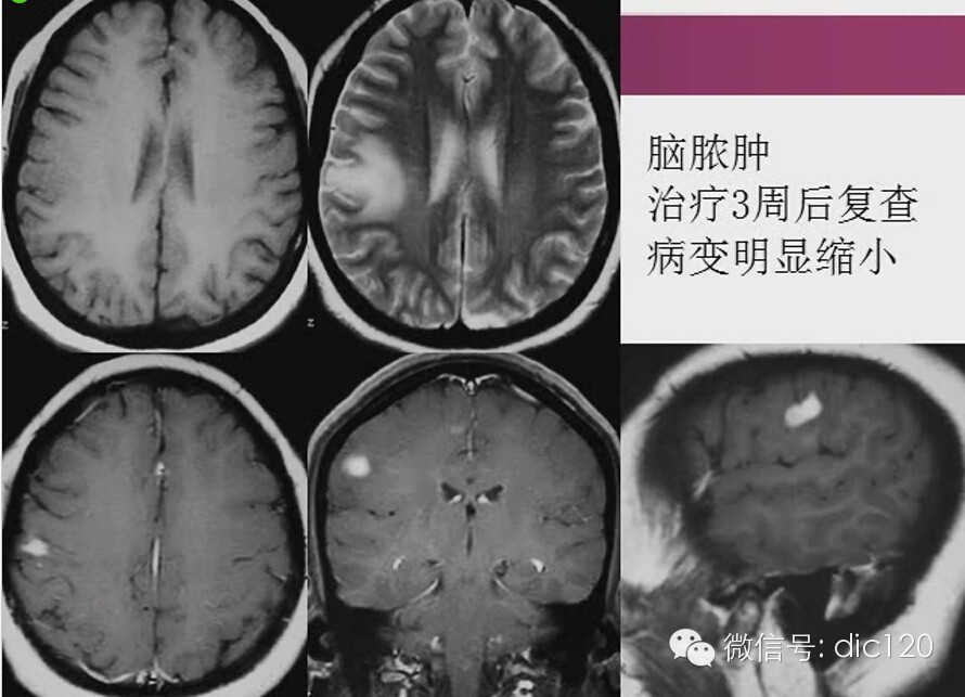 脑内环形强化病变影像诊断思路