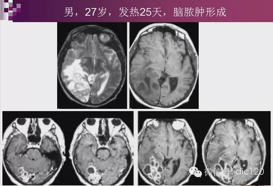 脑内环形强化病变影像诊断思路