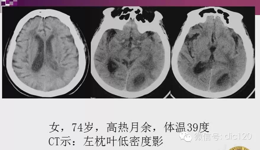 脑内环形强化病变影像诊断思路