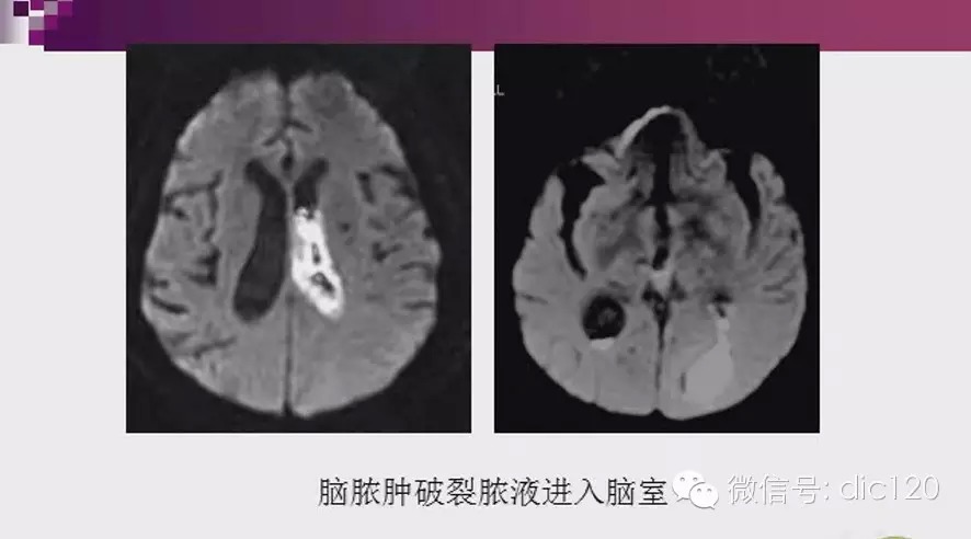 脑内环形强化病变影像诊断思路