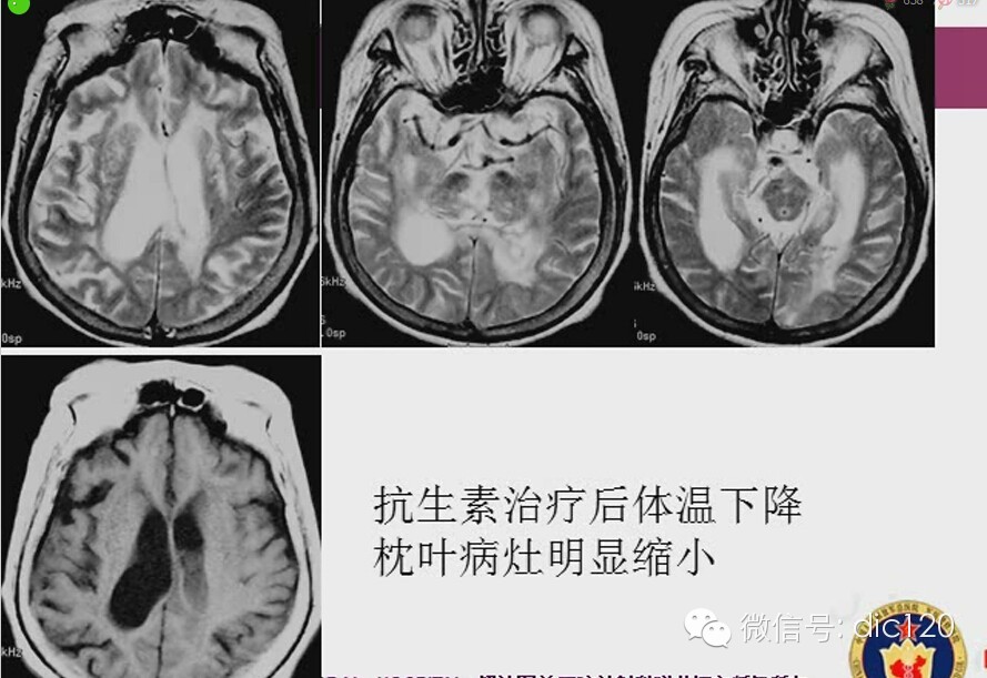 脑内环形强化病变影像诊断思路