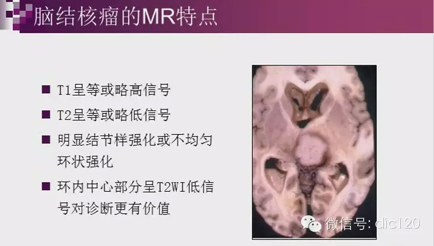 脑内环形强化病变影像诊断思路