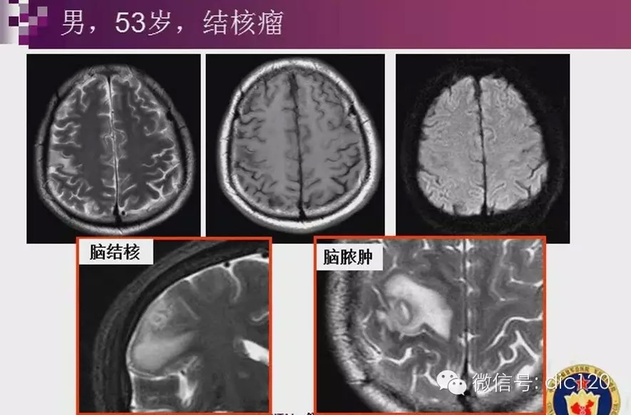 脑内环形强化病变影像诊断思路