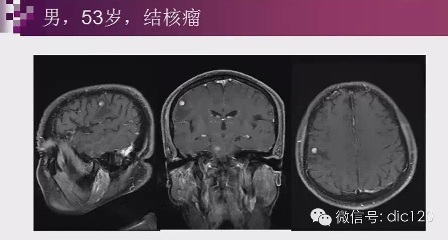 脑内环形强化病变影像诊断思路