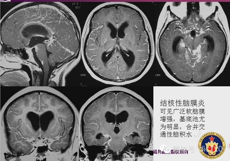 脑内环形强化病变影像诊断思路