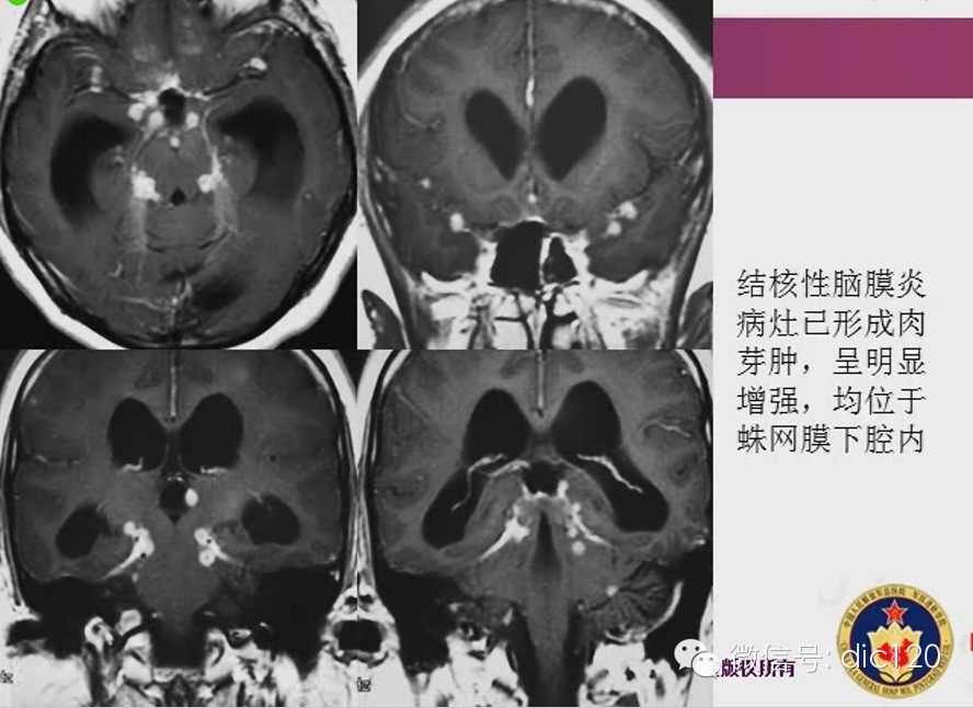 脑内环形强化病变影像诊断思路