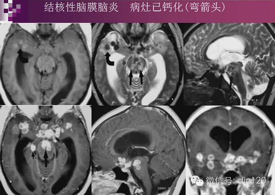 脑内环形强化病变影像诊断思路