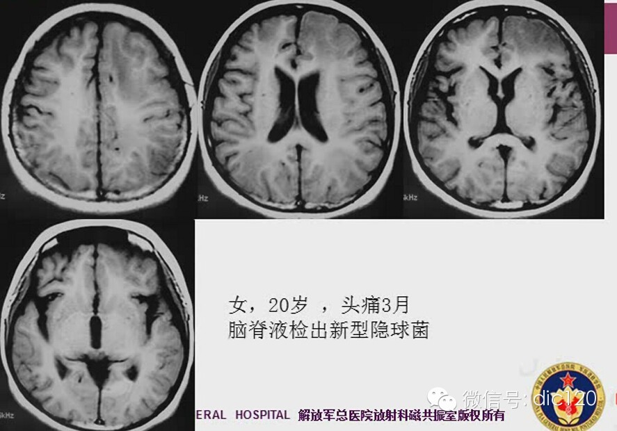 脑内环形强化病变影像诊断思路