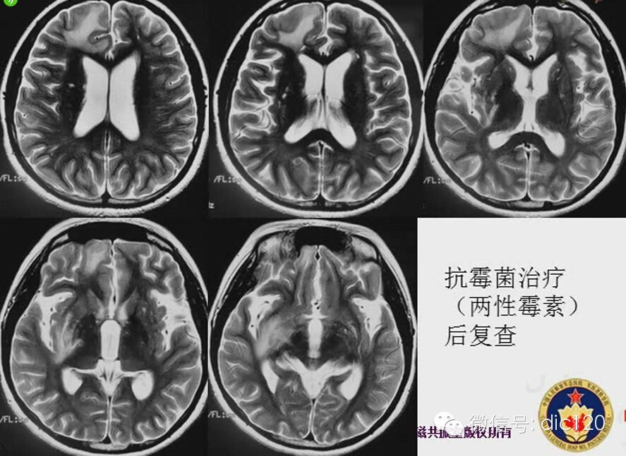 脑内环形强化病变影像诊断思路