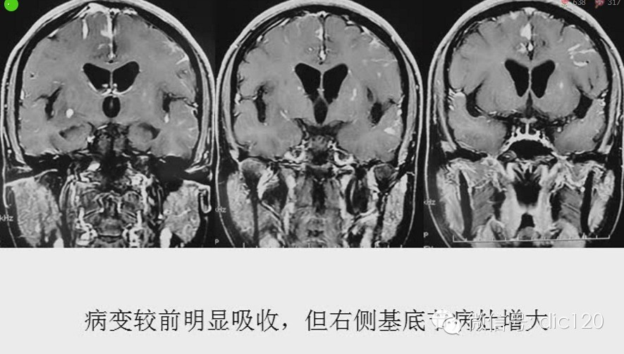脑内环形强化病变影像诊断思路