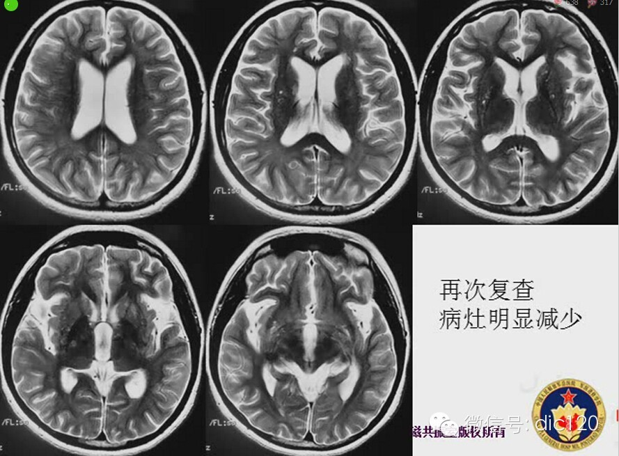 脑内环形强化病变影像诊断思路