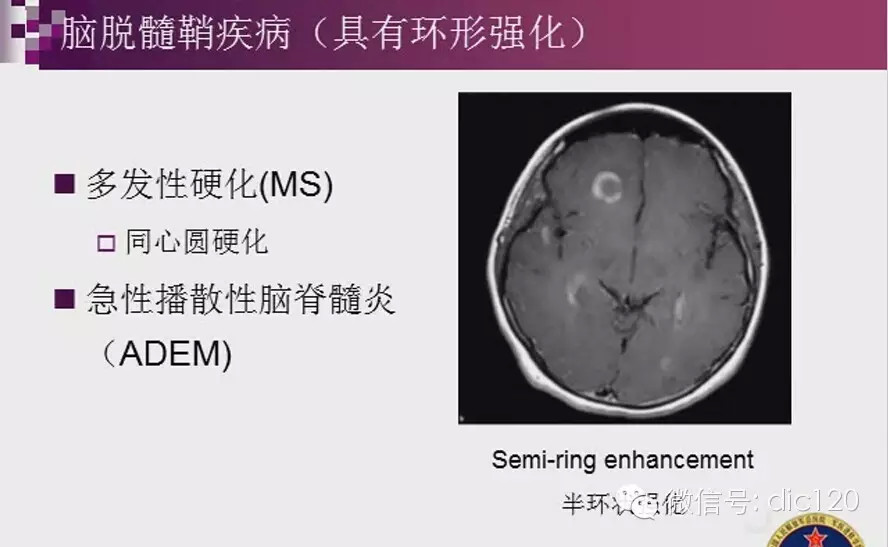脑内环形强化病变影像诊断思路