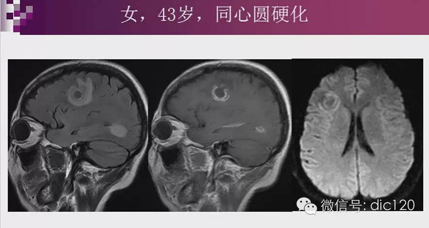 脑内环形强化病变影像诊断思路