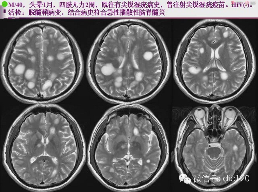 脑内环形强化病变影像诊断思路