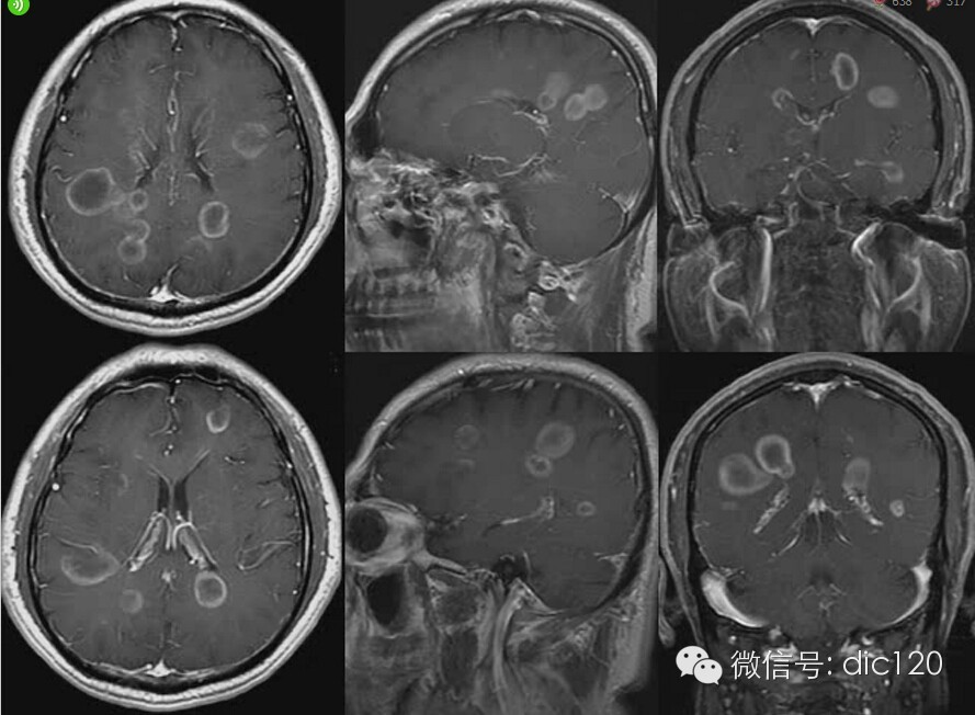 脑内环形强化病变影像诊断思路