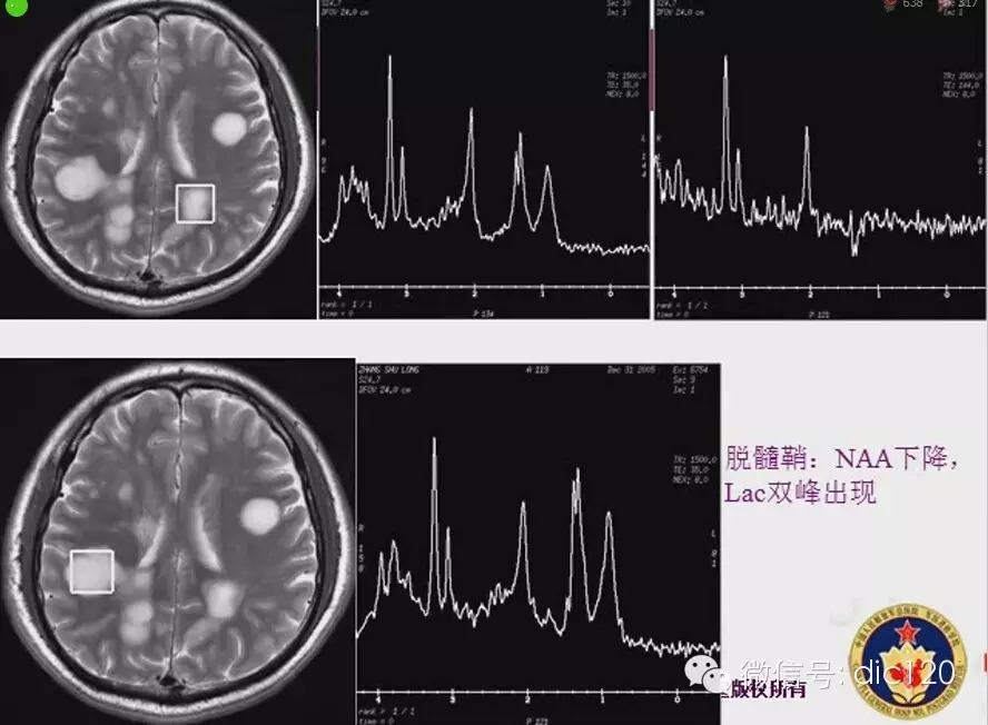 脑内环形强化病变影像诊断思路