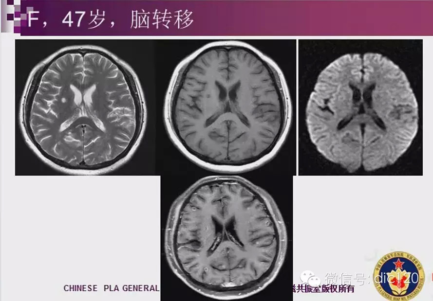 脑内环形强化病变影像诊断思路