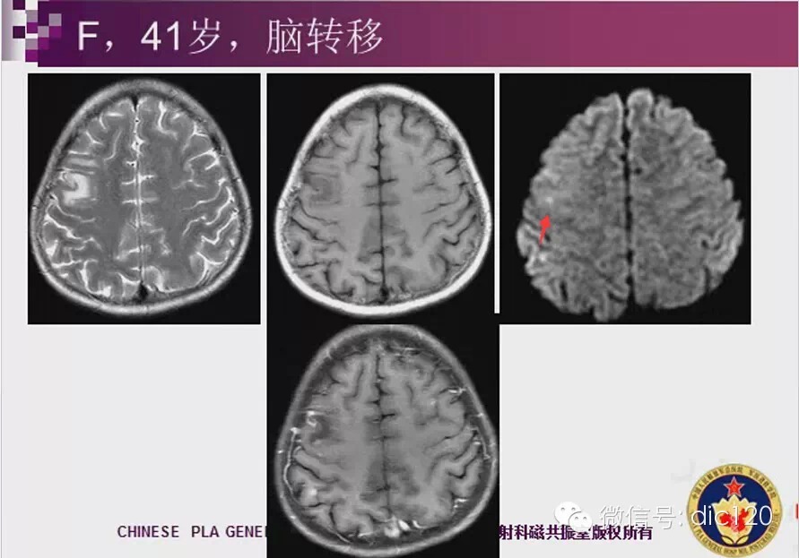 脑内环形强化病变影像诊断思路