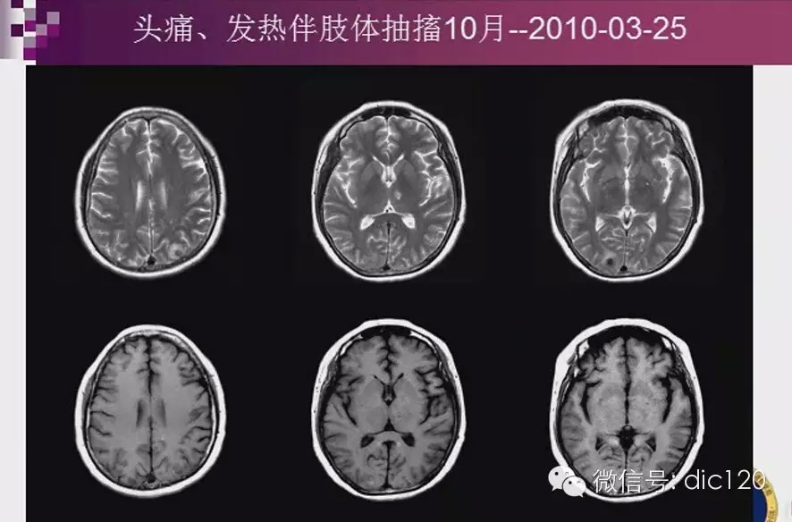 脑内环形强化病变影像诊断思路