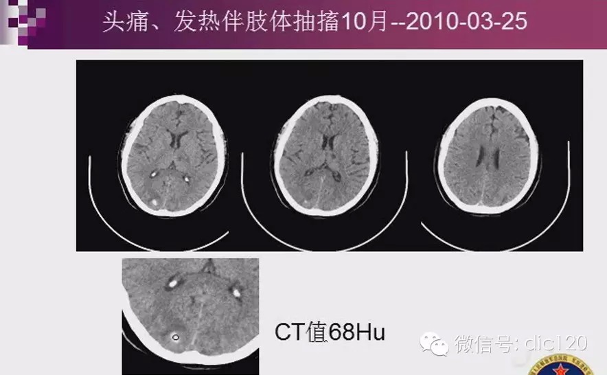 脑内环形强化病变影像诊断思路