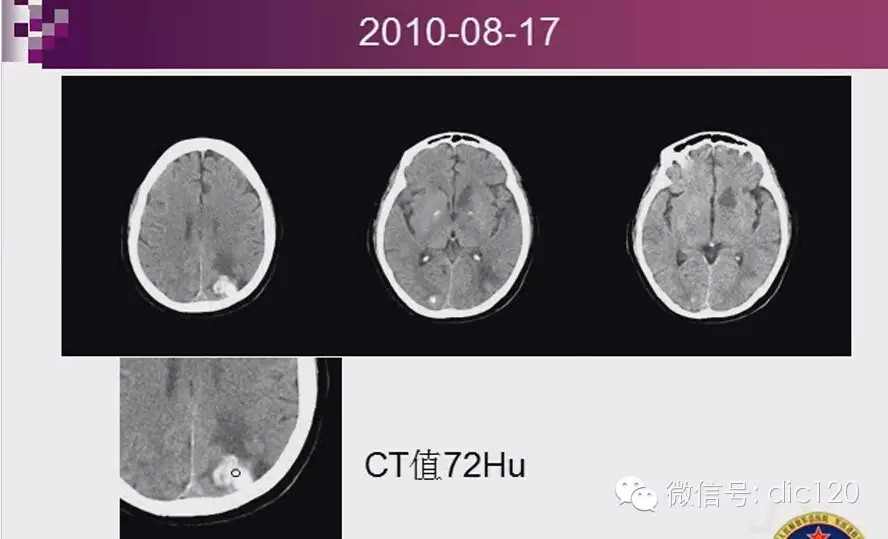 脑内环形强化病变影像诊断思路