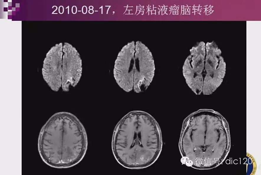脑内环形强化病变影像诊断思路