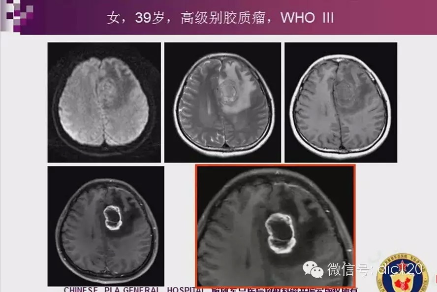 脑内环形强化病变影像诊断思路