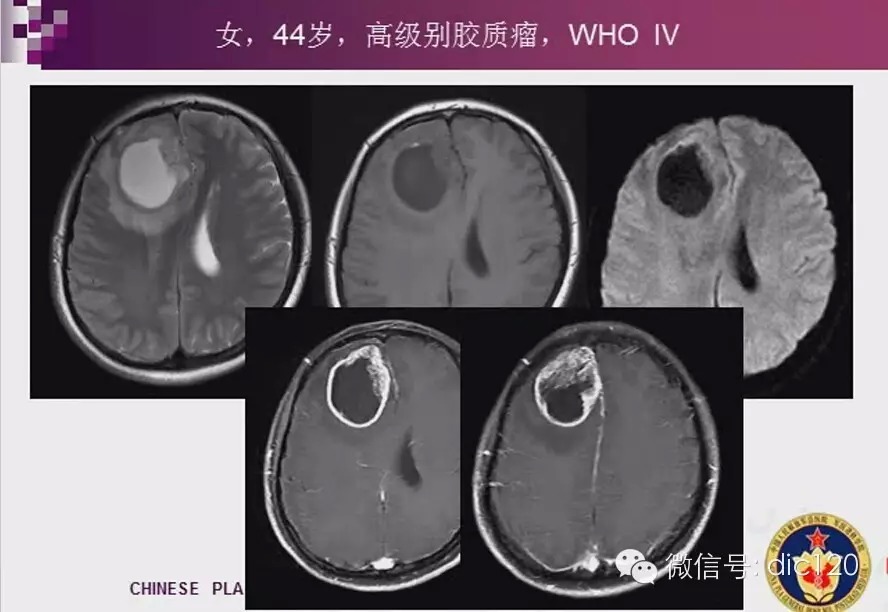 脑内环形强化病变影像诊断思路