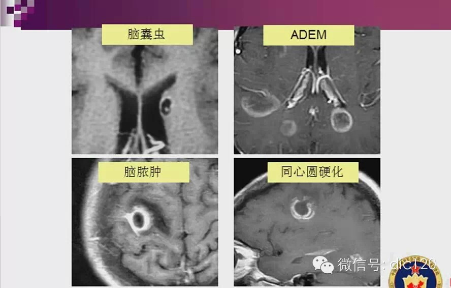 脑内环形强化病变影像诊断思路