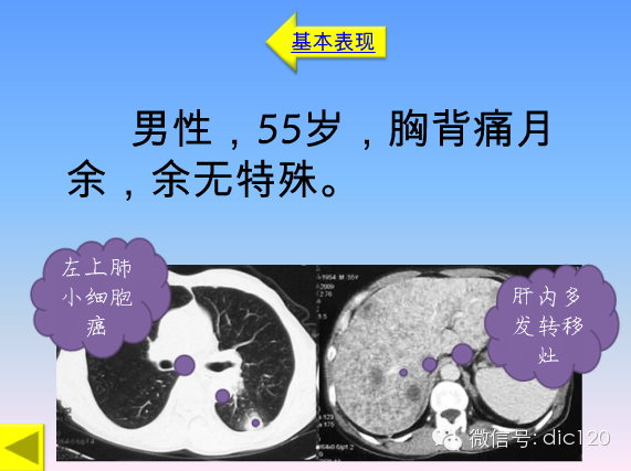 小细胞肺癌的临床CT病理特点及其征象分析