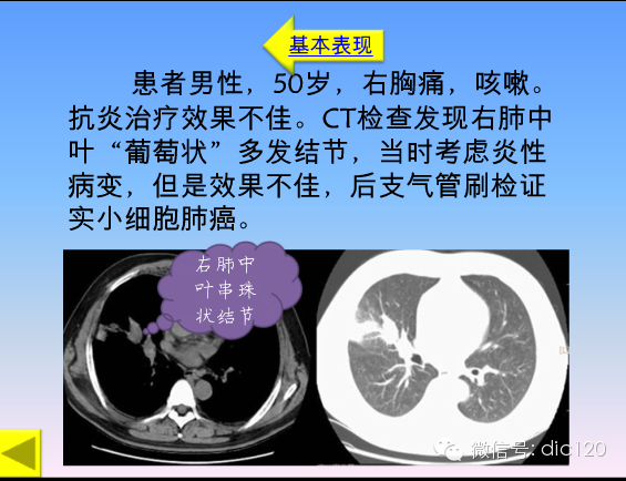 小细胞肺癌的临床CT病理特点及其征象分析