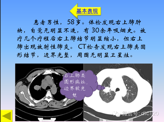 小细胞肺癌的临床CT病理特点及其征象分析