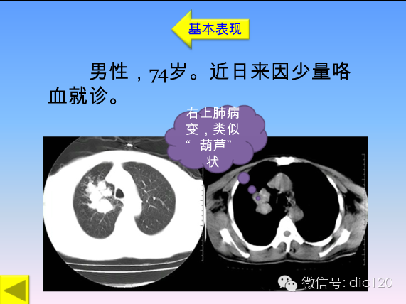 小细胞肺癌的临床CT病理特点及其征象分析