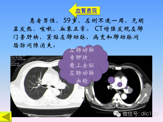 小细胞肺癌的临床CT病理特点及其征象分析