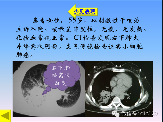 小细胞肺癌的临床CT病理特点及其征象分析