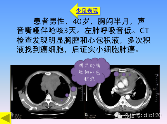 小细胞肺癌的临床CT病理特点及其征象分析