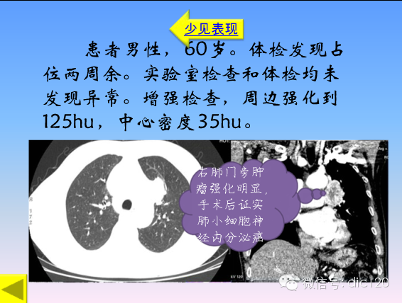 小细胞肺癌的临床CT病理特点及其征象分析