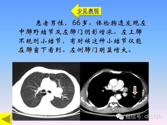 小细胞肺癌的临床CT病理特点及其征象分析