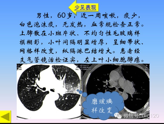 小细胞肺癌的临床CT病理特点及其征象分析