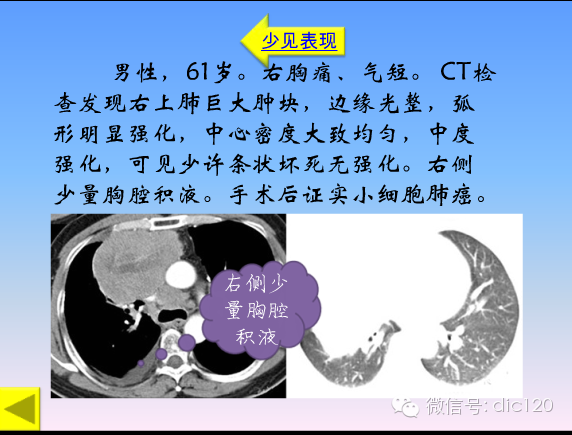 小细胞肺癌的临床CT病理特点及其征象分析