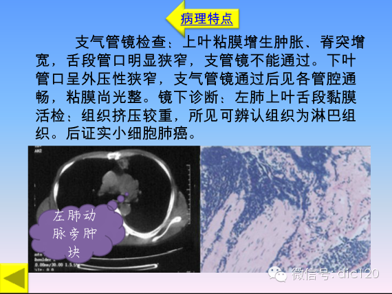 小细胞肺癌的临床CT病理特点及其征象分析