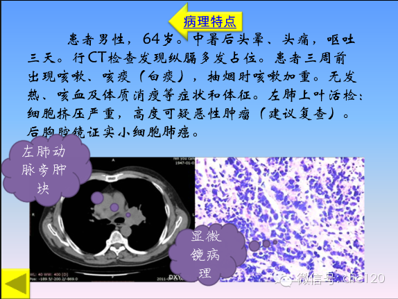 小细胞肺癌的临床CT病理特点及其征象分析
