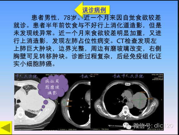 小细胞肺癌的临床CT病理特点及其征象分析