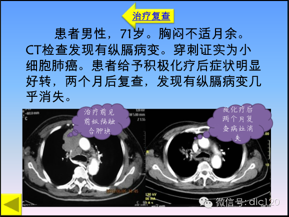 小细胞肺癌的临床CT病理特点及其征象分析