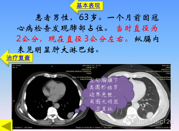 小细胞肺癌的临床CT病理特点及其征象分析